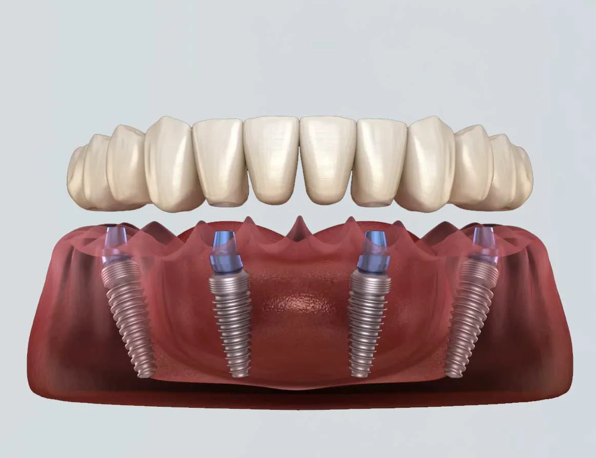 Dental Implants