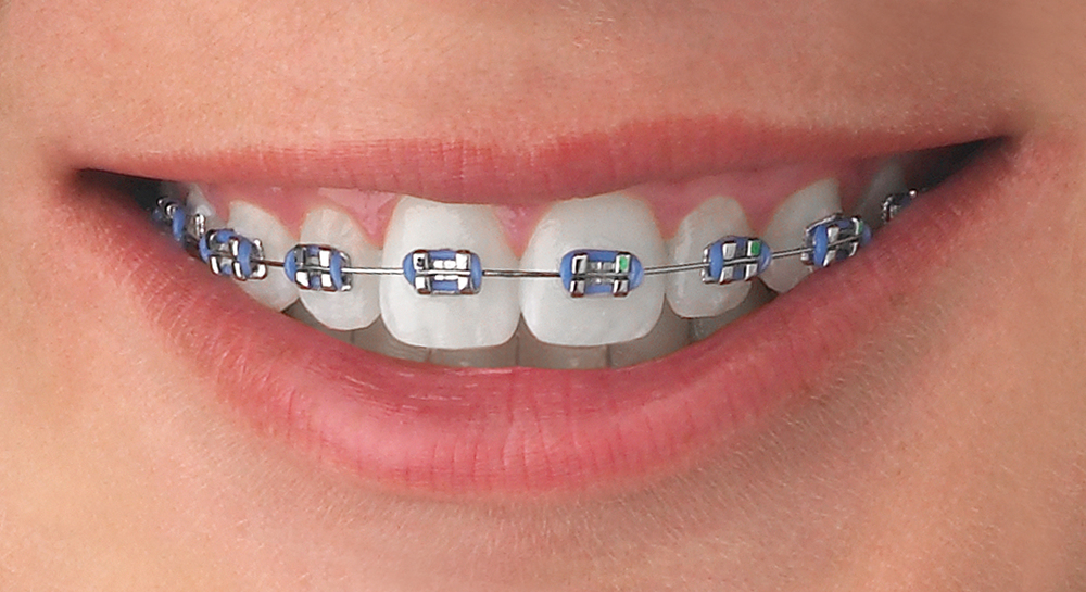 Orthodontics — Braces